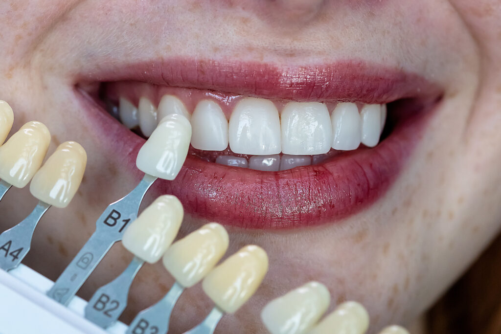 Luxury cosmetic dentistry concept. Dentist selecting veneer shade for perfect white smile. Premium aesthetic dental treatment and smile makeover process.