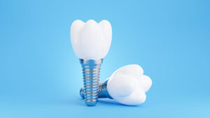 3d render of dental implant on blue background