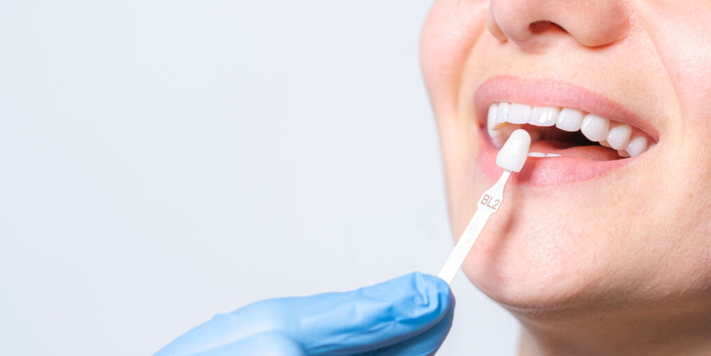 Banner tooth whitening, perfect white teeth close up with shade guide bleach color, female veneer smile, dental care and stomatology, dentistry, copyspace.